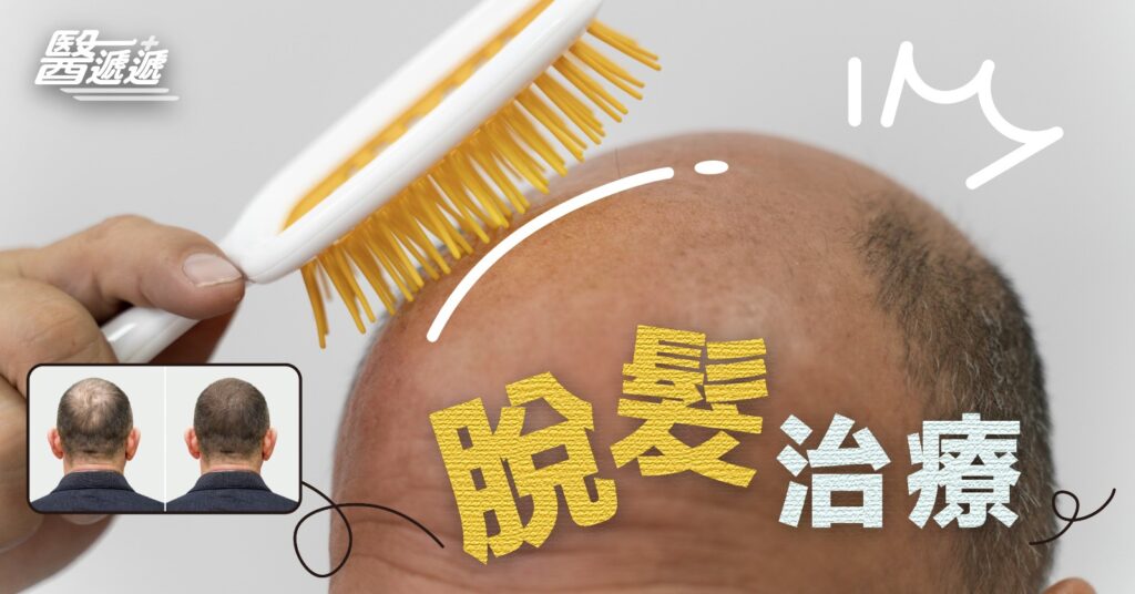 為什麼會脫髮?